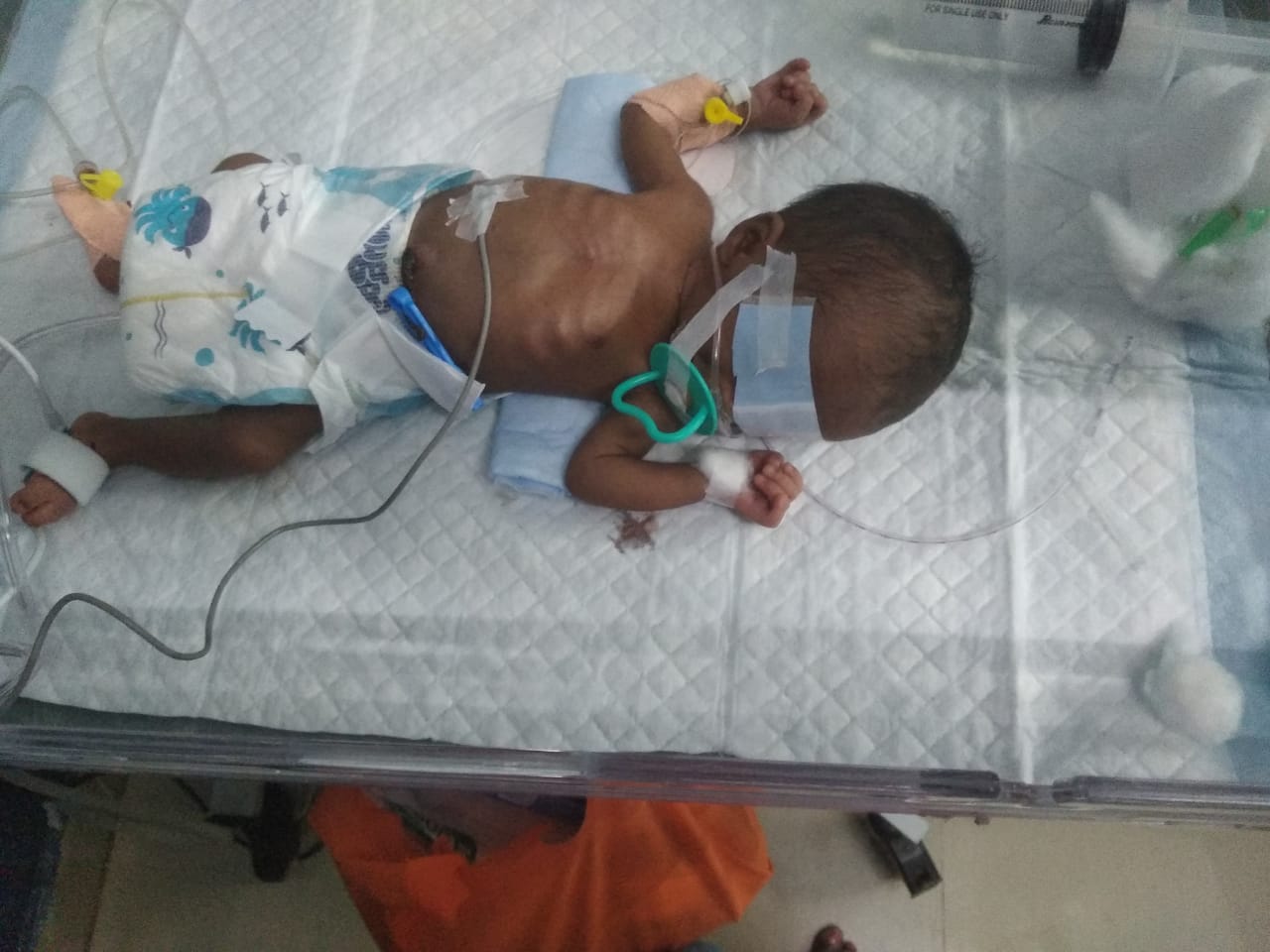 Support My Baby Struggling From Premature And Sepsis