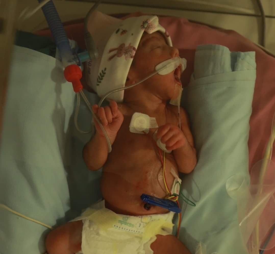 Help Rangamma's New Born Baby To Fight Respiratory Distress Syndrome
